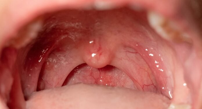 Oral Cancer